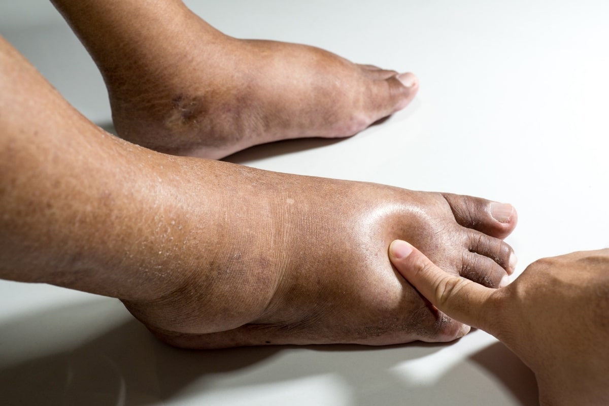 8 Surprising Causes of Edema: Uncover the Truth!