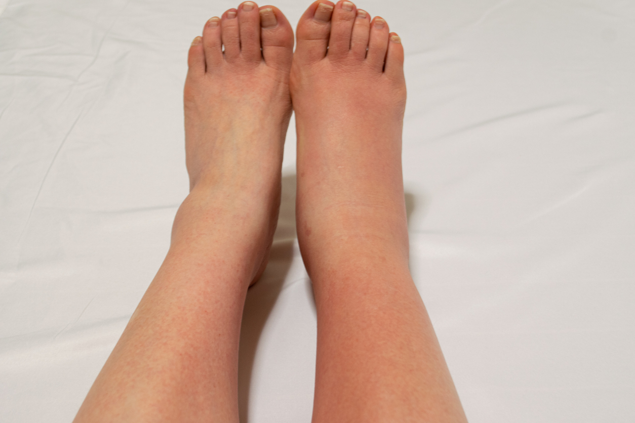 Natural Ways to Reverse Edema Swelling in Your Legs