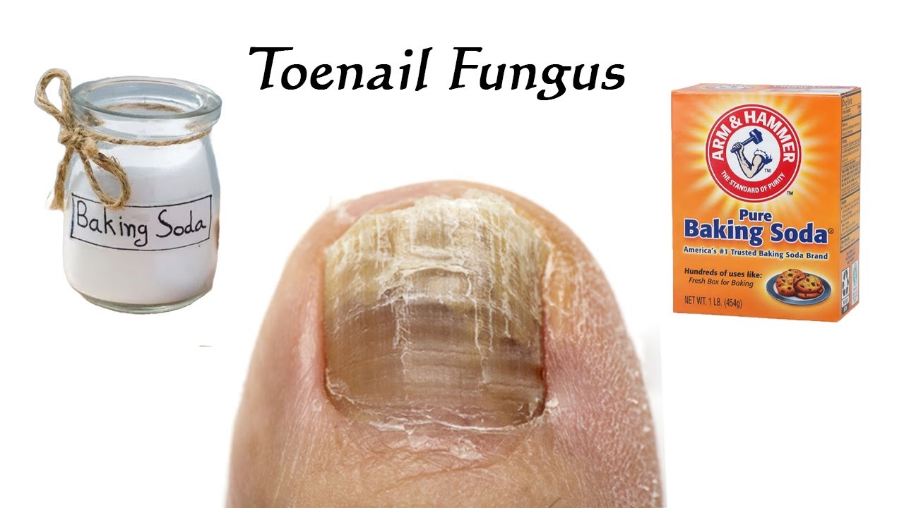 Say Goodbye to Toenail Fungus with This Natural Remedy