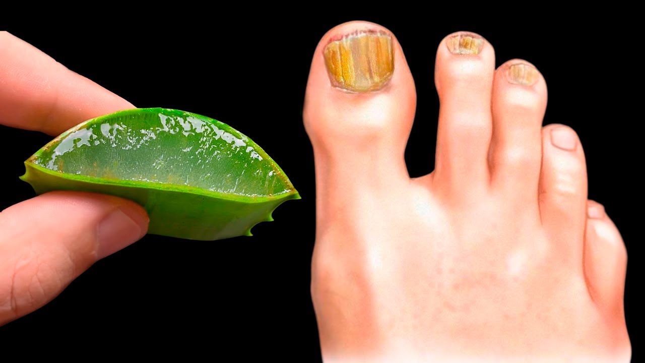 Discover the Magic of Aloe Vera: The Ultimate Nail Fungus Killer!