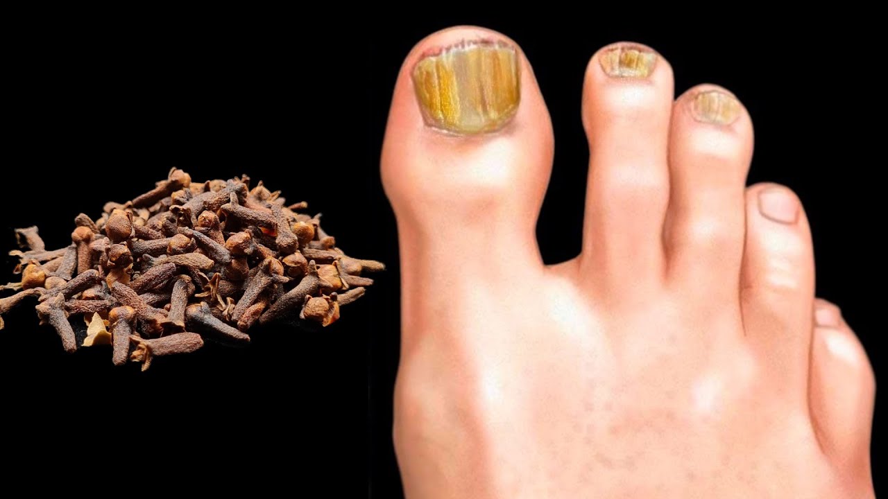 Removes Nail Fungus Instantly, Like an Eraser! The Best Remedy!