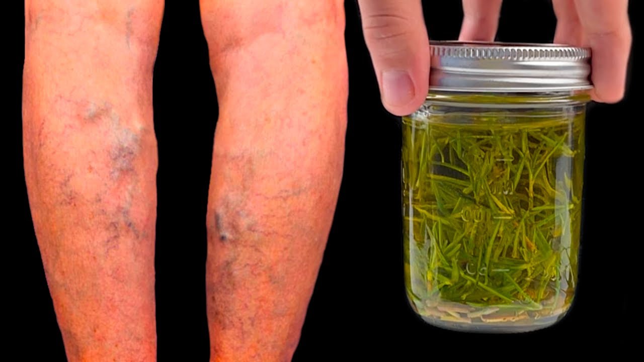 Unbelievable! Varicose Veins Disappear with Rosemary! A Treasure Everyone Should Have