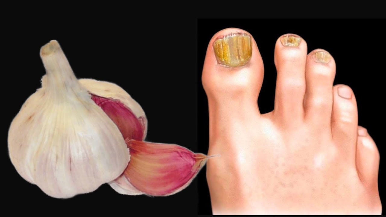 Garlic: Your Natural Remedy for Nail Fungus