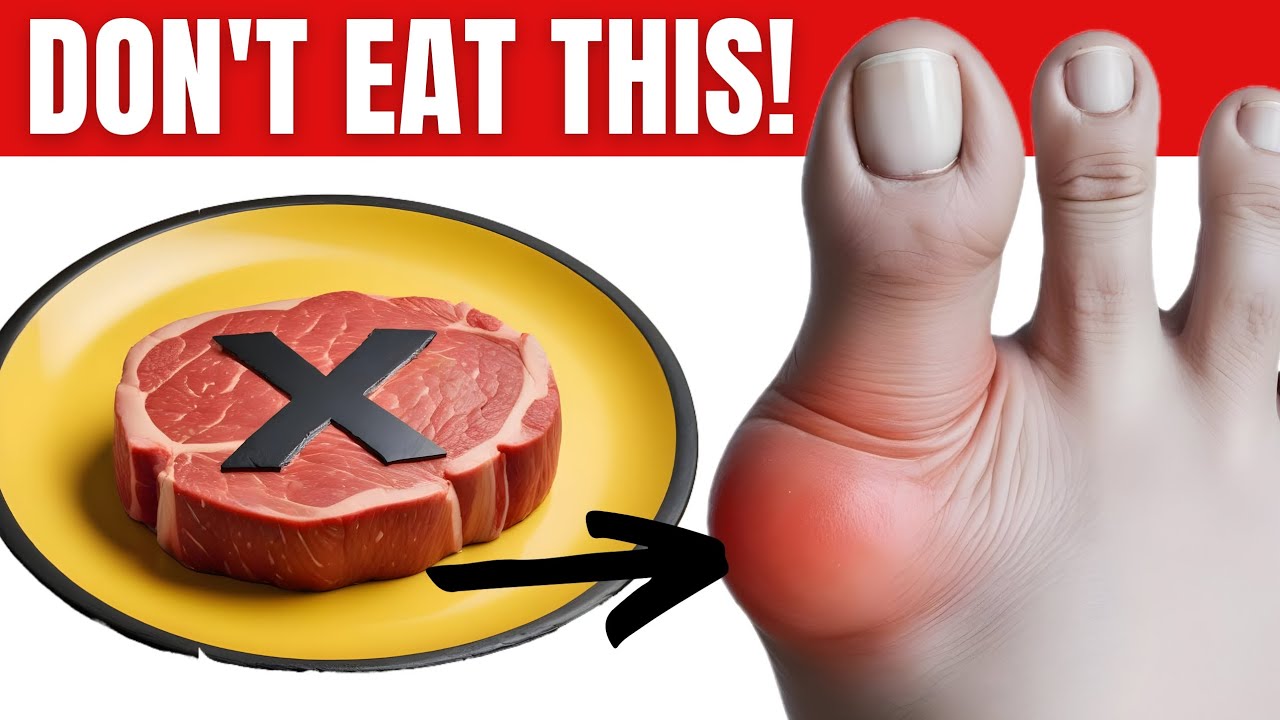 Living Well with Gout: Foods to Avoid for a Pain-Free Lifestyle