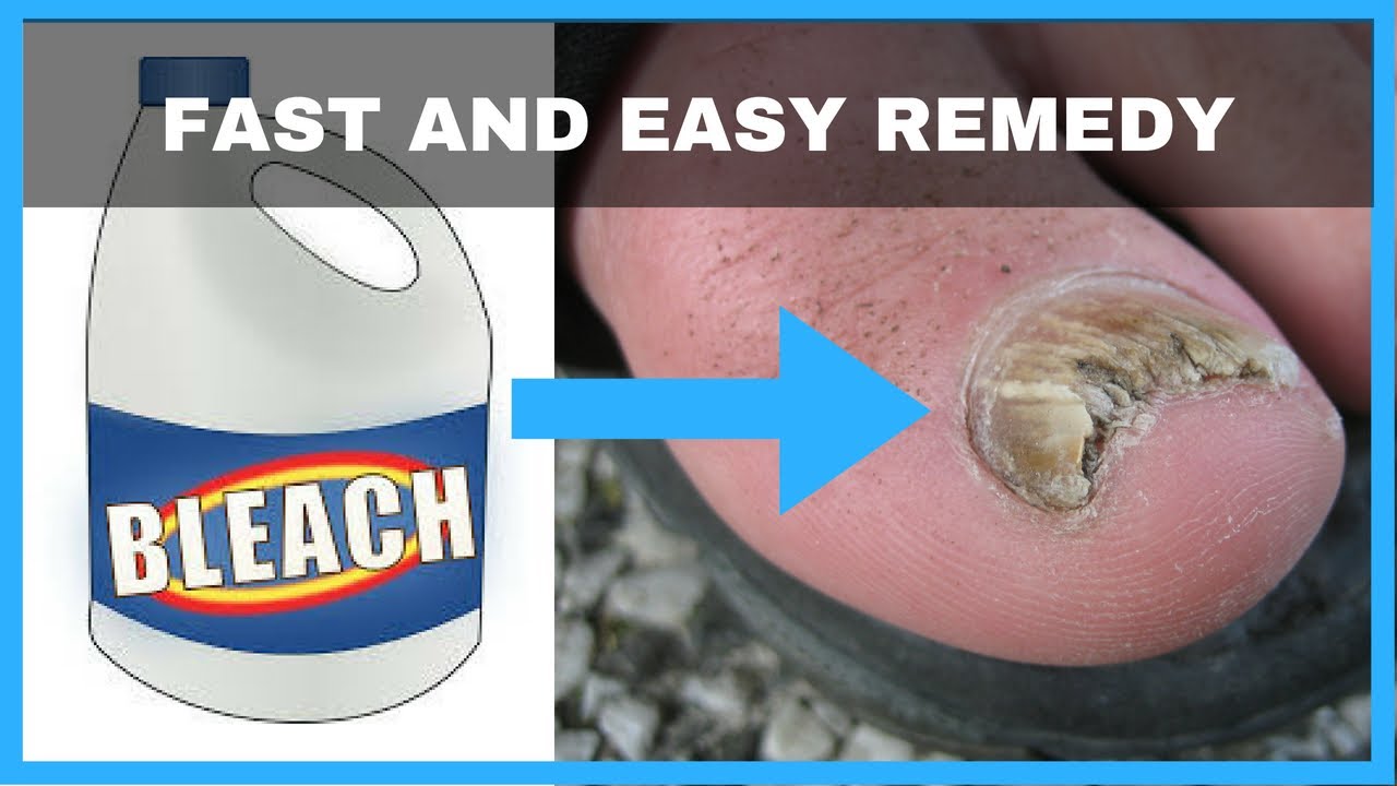 How to Get Rid of Toenail Fungus with Bleach: A Step-by-Step Guide