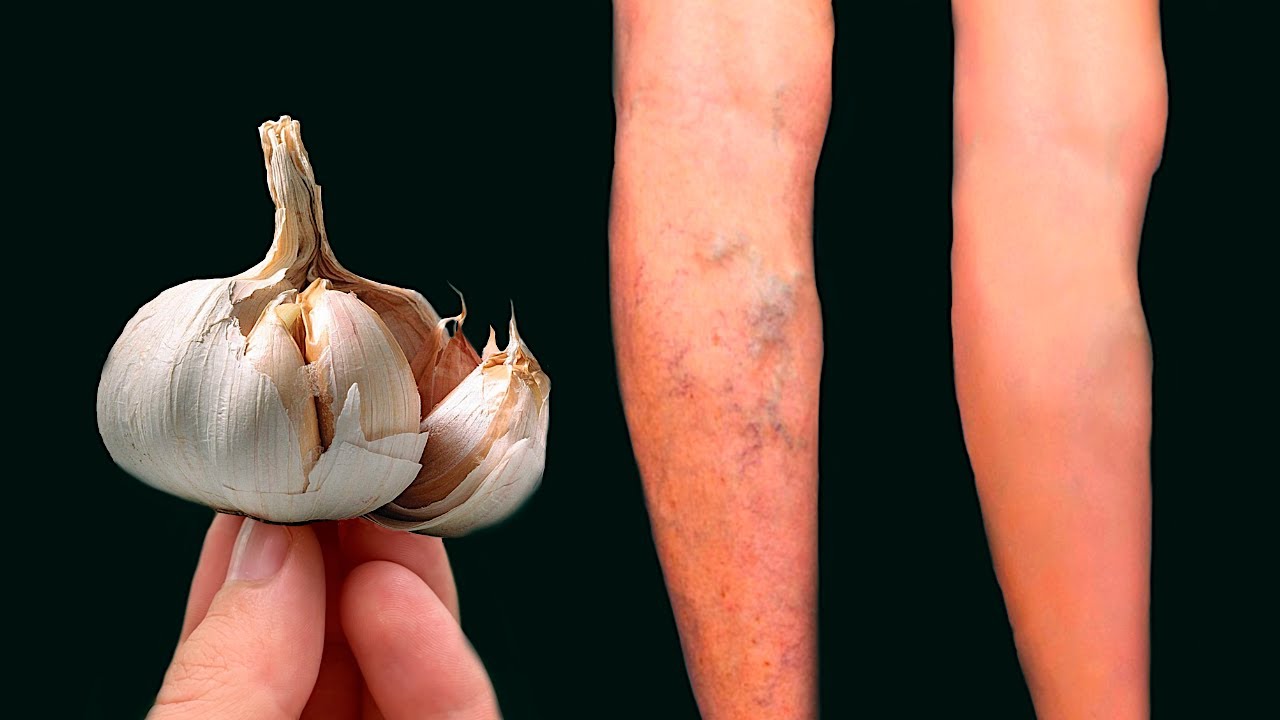 Unlock the Power of Garlic to Combat Varicose Veins and Clots