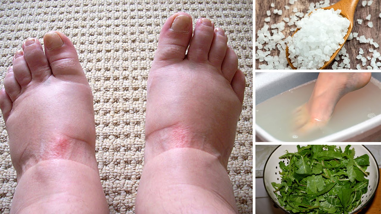 Home Remedies for Swollen Feet: Simple and Effective Solutions