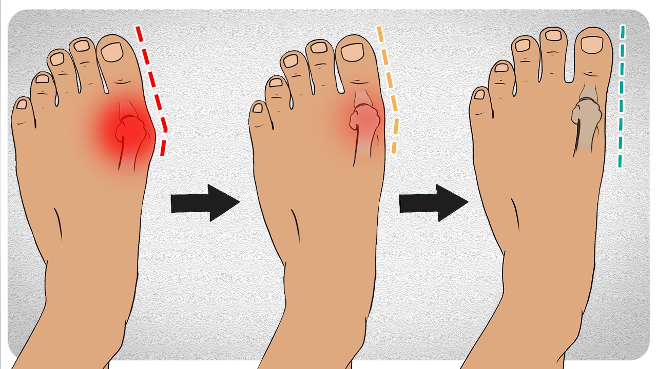 Five Steps to Manage Bunions Effectively