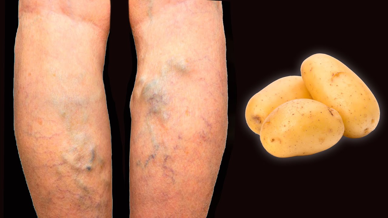 Discover the Simple Power of Potatoes for Varicose Veins Relief