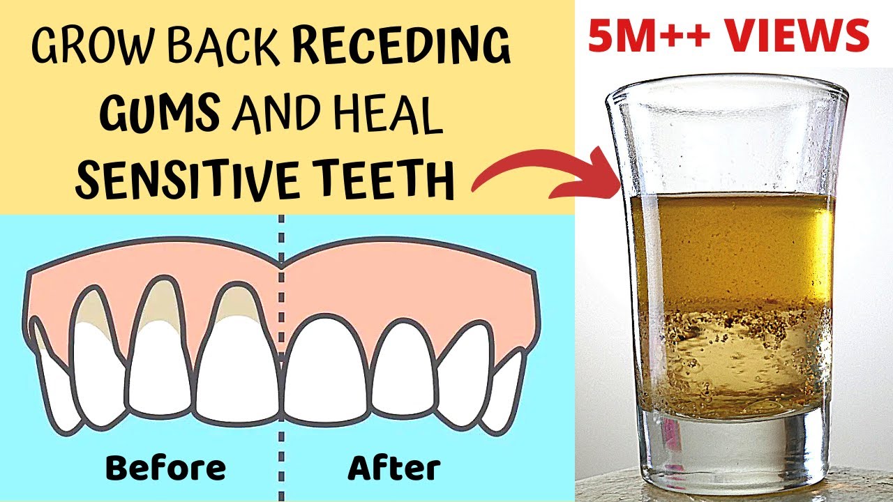 How to Heal Receding Gums and Treat Sensitive Teeth Naturally