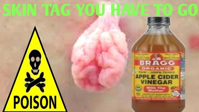 Removing Skin Tags with Apple Cider Vinegar: A Simple Guide