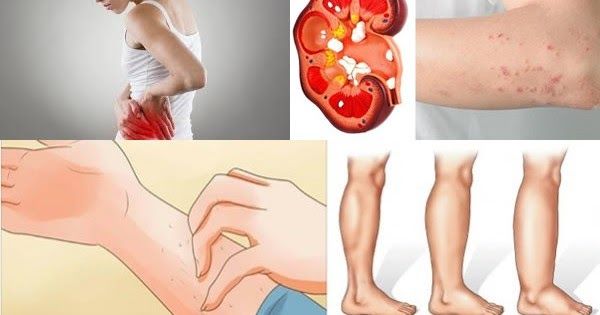 Signs that Your Kidneys May be in Danger