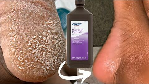 Try Hydrogen Peroxide on Your Feet and See What Happens – The Results Are Shocking!