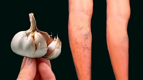 Garlic for Varicose Veins: A Natural Solution for Circulatory Health