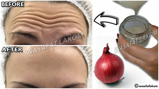 1 Onion: Nature’s Powerful Anti-Wrinkle Remedy