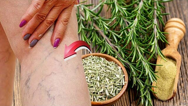 The Remarkable Power of Rosemary for Varicose Veins