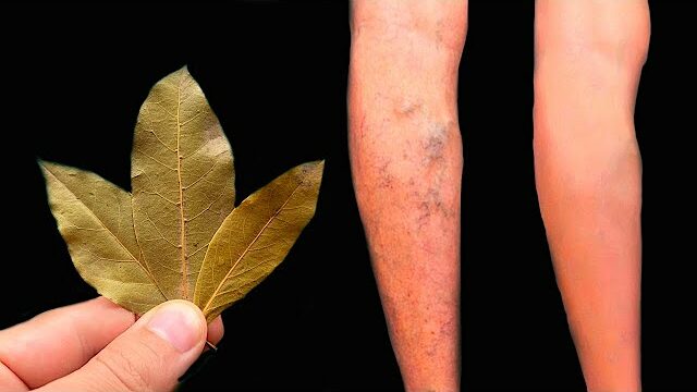 Unbelievable! Get Rid of Varicose Veins with Bay Leaf! This Treasure Should Be in Every Home