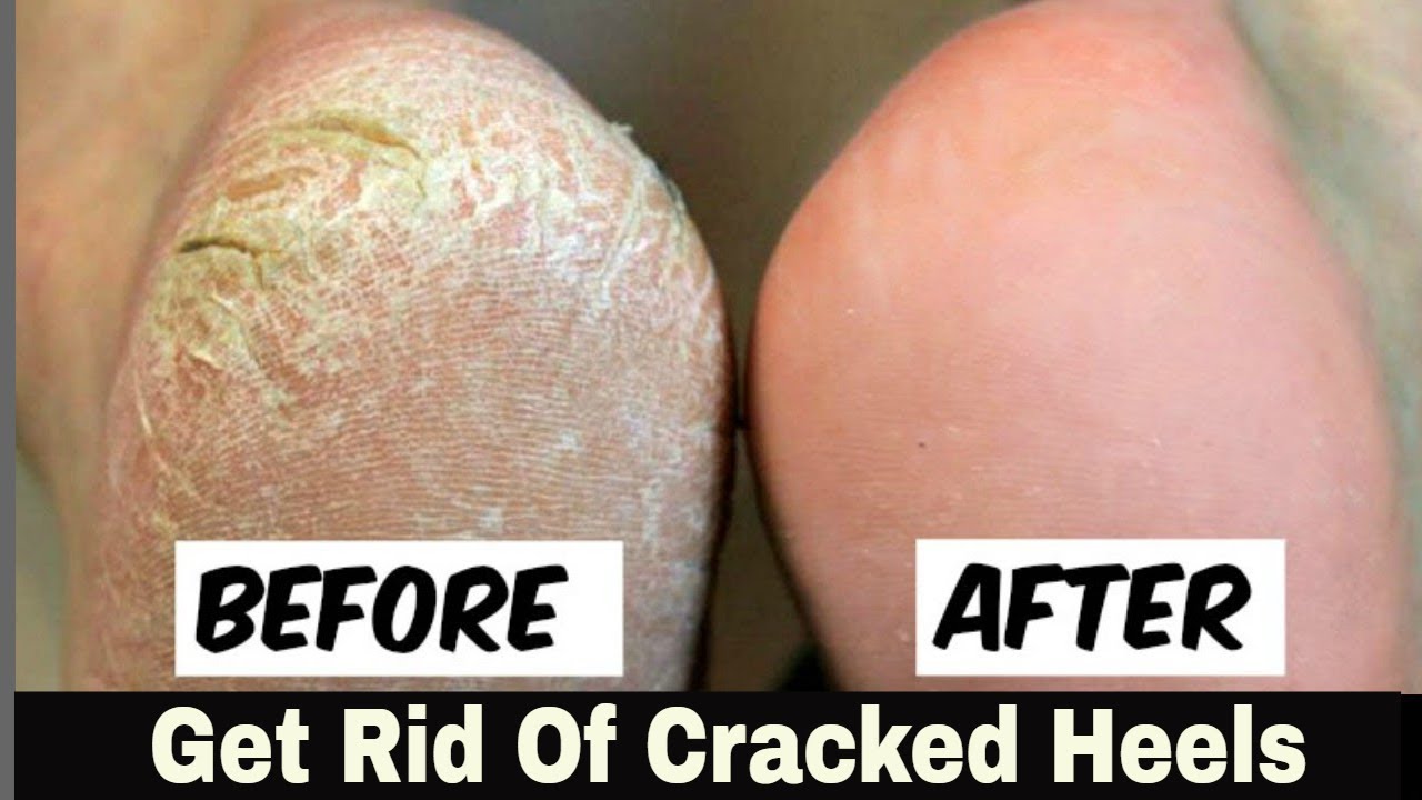 Home Remedy to Remove Cracked Heels Fast “OVERNIGHT” – Great Results