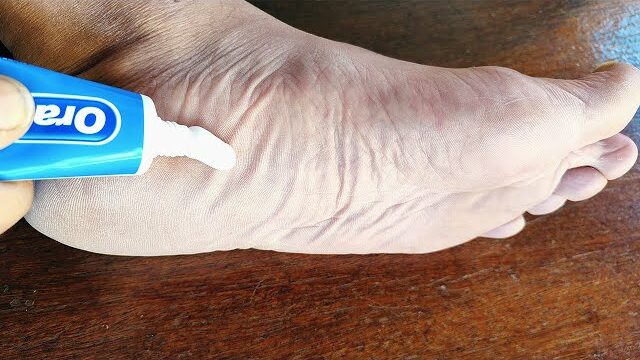 Toothpaste on Your Feet: A Surprising Home Remedy