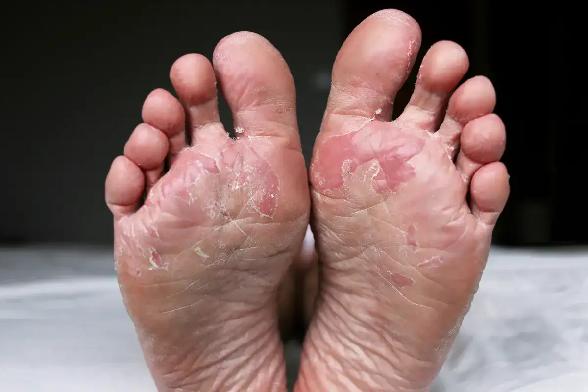 7 Easy Home Remedies to Treat Foot Fungus