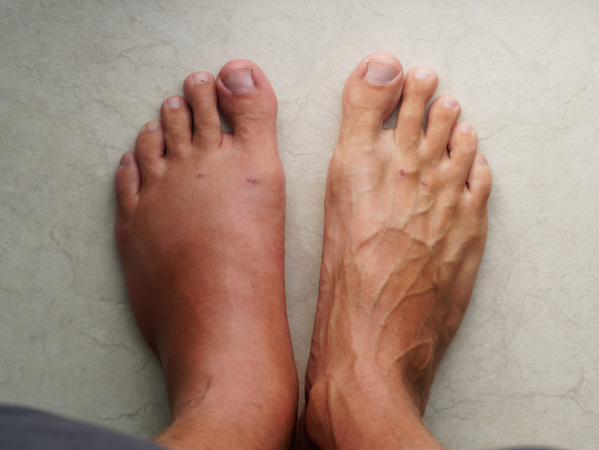 The Power of Vitamin B6: A Natural Solution for Reducing Swelling in Legs and Feet