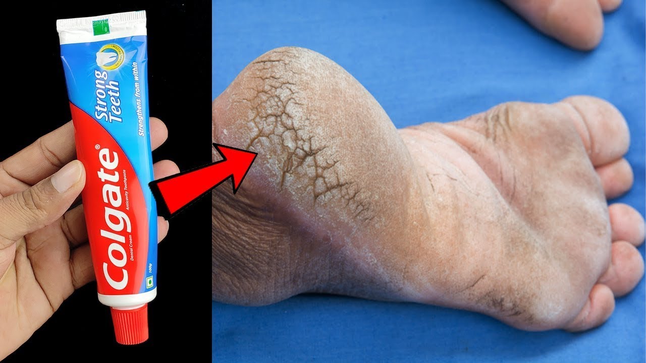 Smooth and Soft: Heal Cracked Heels with Toothpaste in Just 3 Days