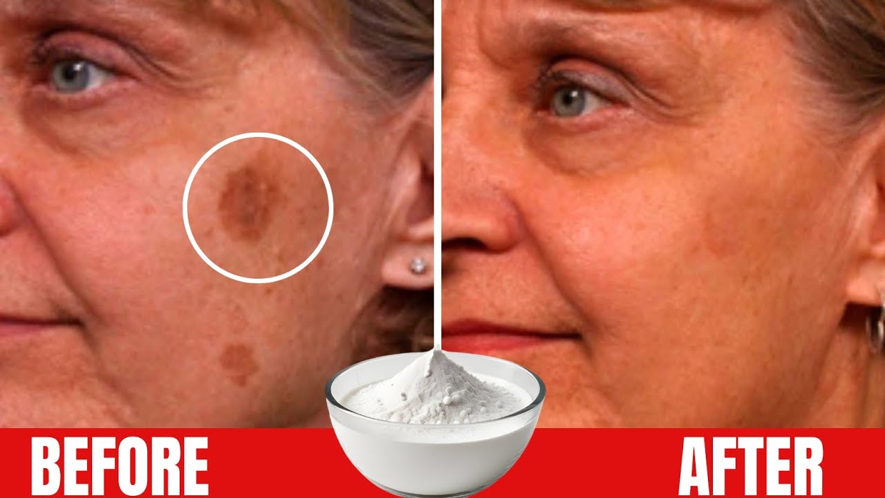 Baking Soda Erases Skin Spots: Try This for Shocking Results!