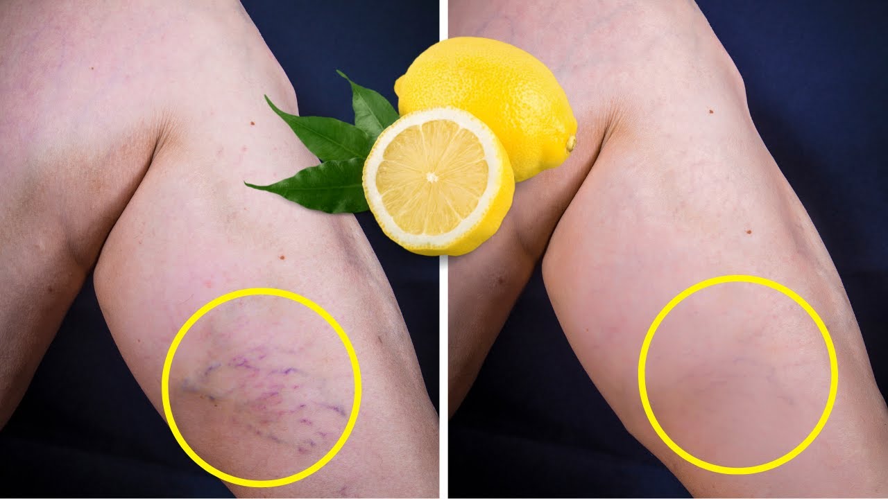 Lemon Removes Varicose Veins! Just Do This Every Day…