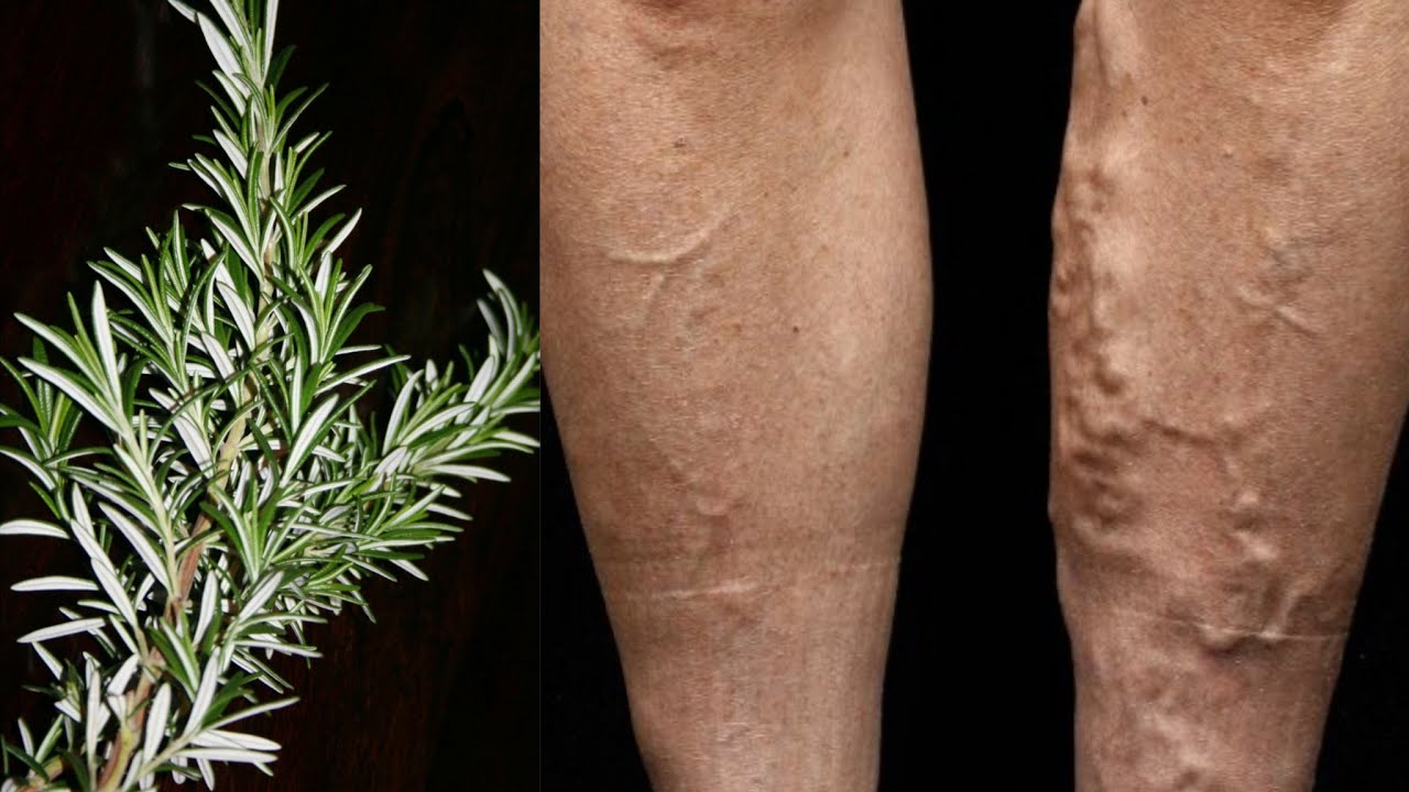 Unbelievable! Get Rid of Varicose Veins with Rosemary