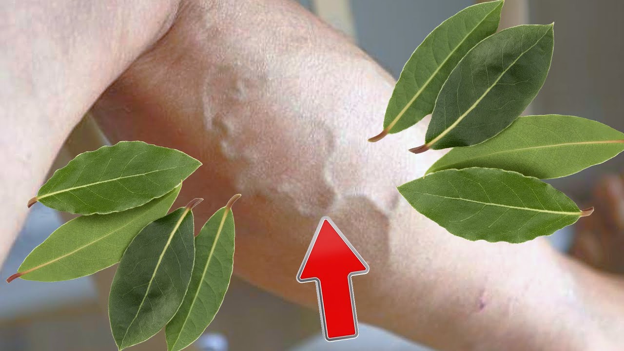 Amazing Natural Remedy for Varicose Veins: Just One Simple Step a Day!