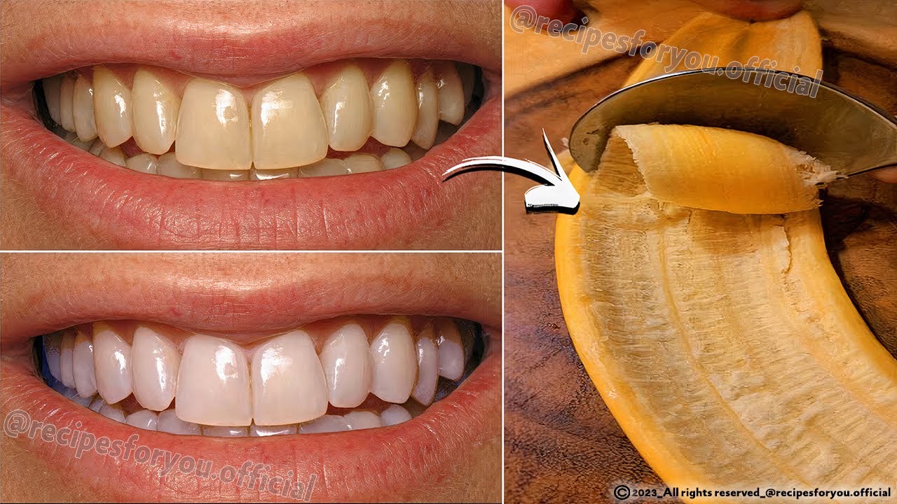 Unlock the Secret: Using Banana Peel for Tartar Removal and Teeth Whitening