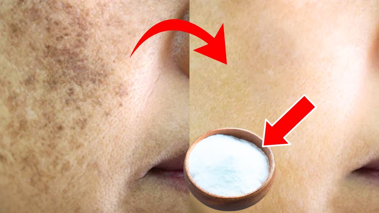 Erasing Age Spots Naturally with Baking Soda