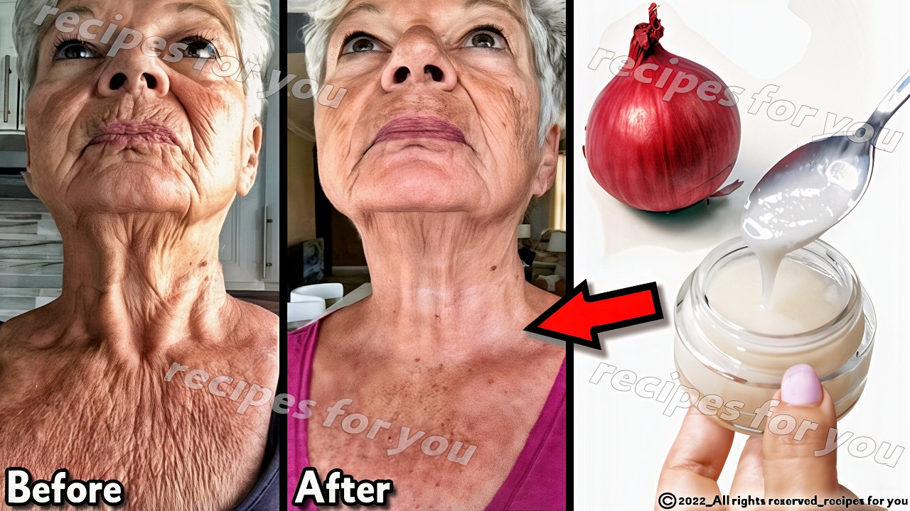 Discover the Natural Wrinkle Fighter: Onion Juice for Your Skin