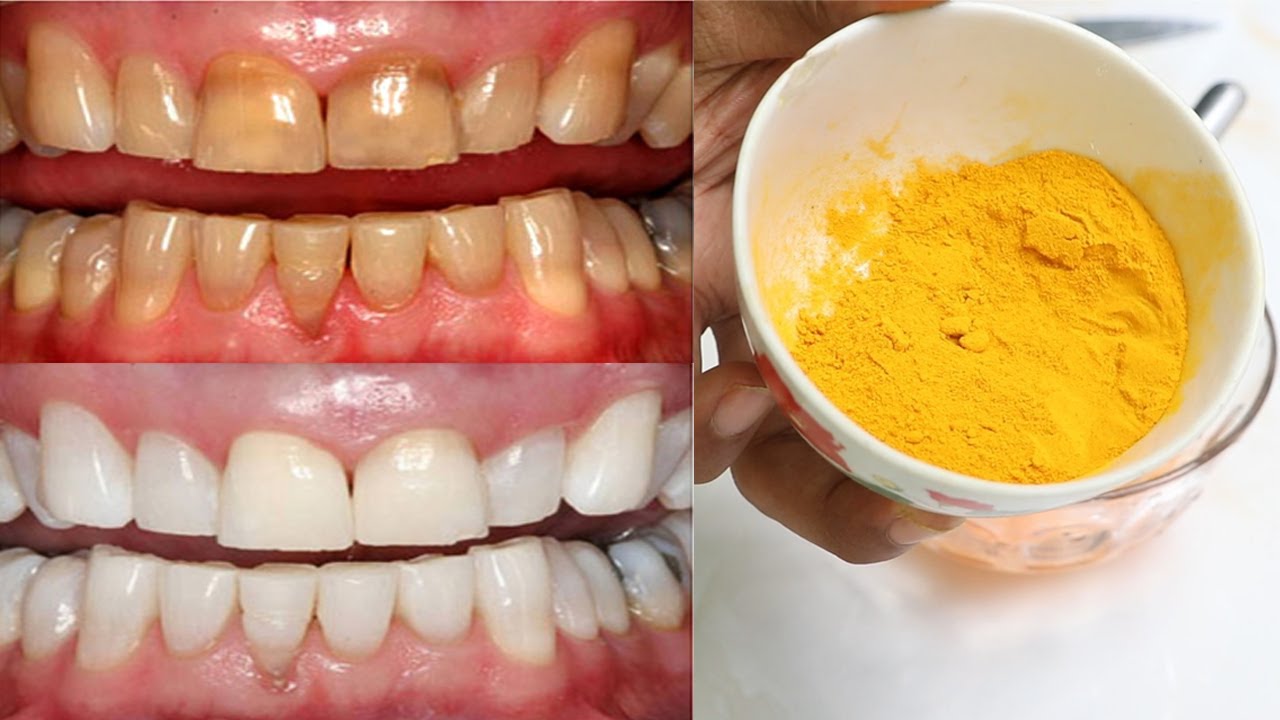 Turmeric: The Natural Secret for Tartar Removal and Teeth Whitening