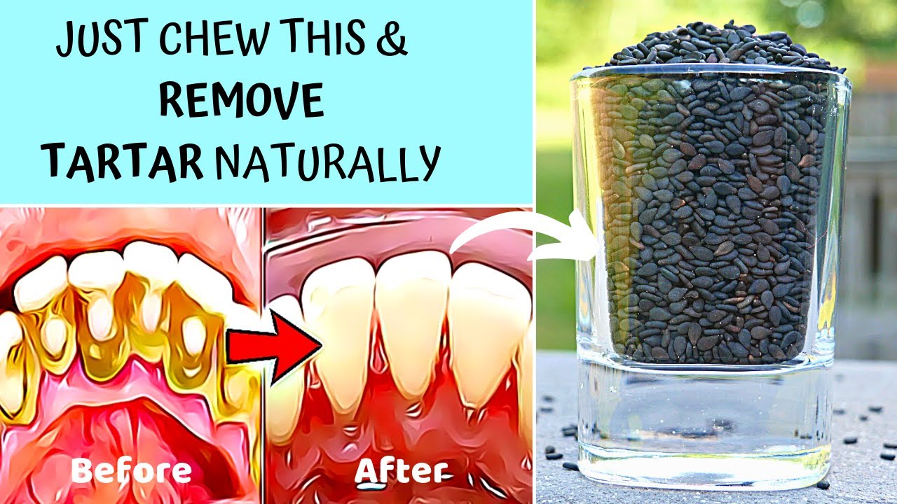 5 Natural Ways to Remove Tartar Buildup & Plaque