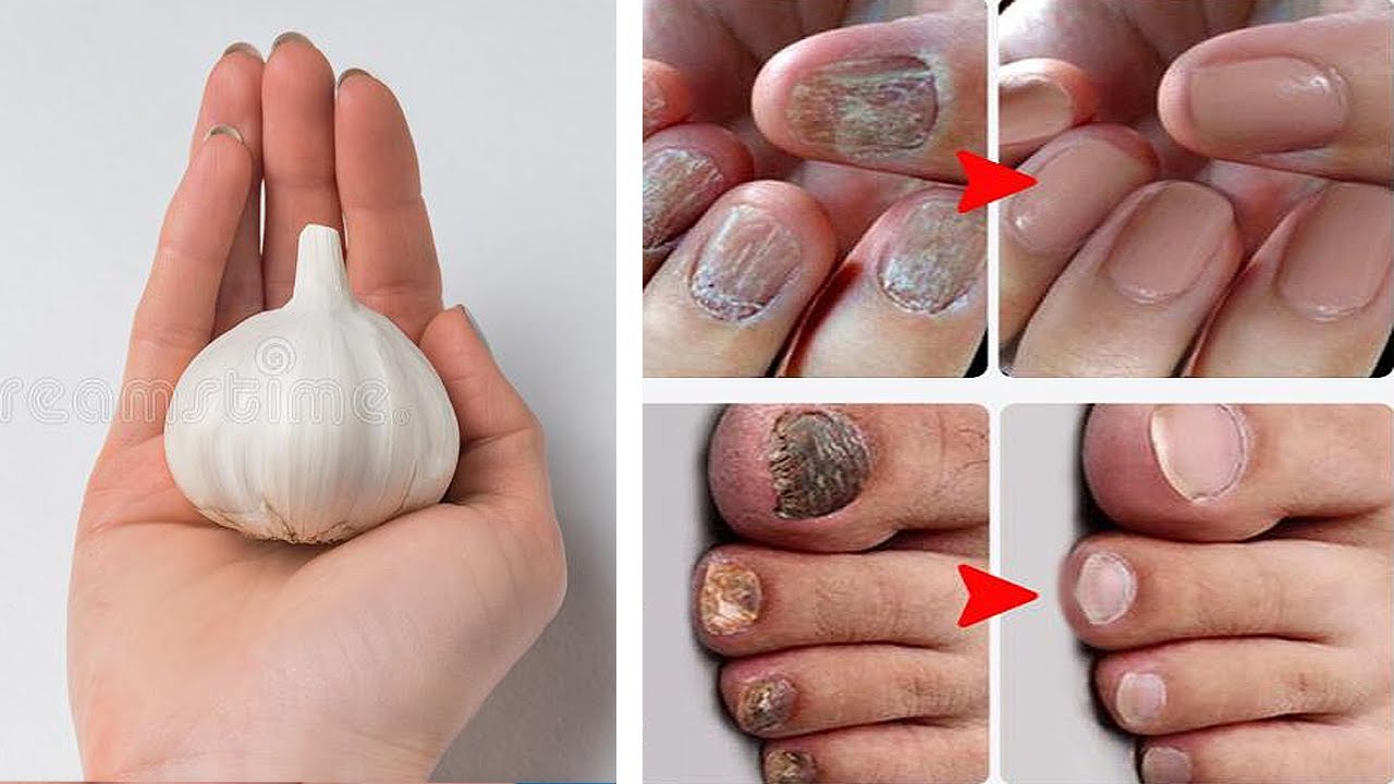 Erase Nail Fungus Naturally: Discover the Power of Garlic