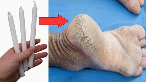 With a Candle, Get Rid of Cracked Heels in Just 1 Day