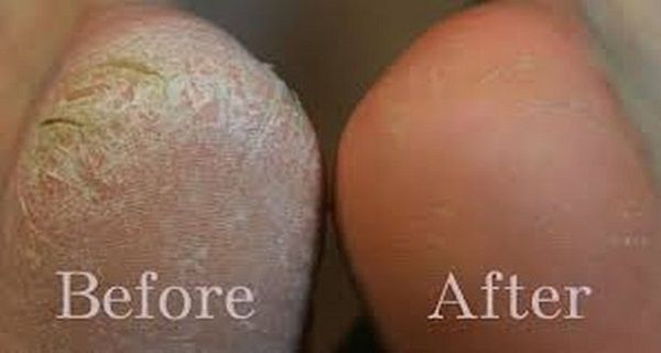 How to Remove Dead Skin from Your Feet Naturally at Home 2024 | Cracked Heels Home Remedy