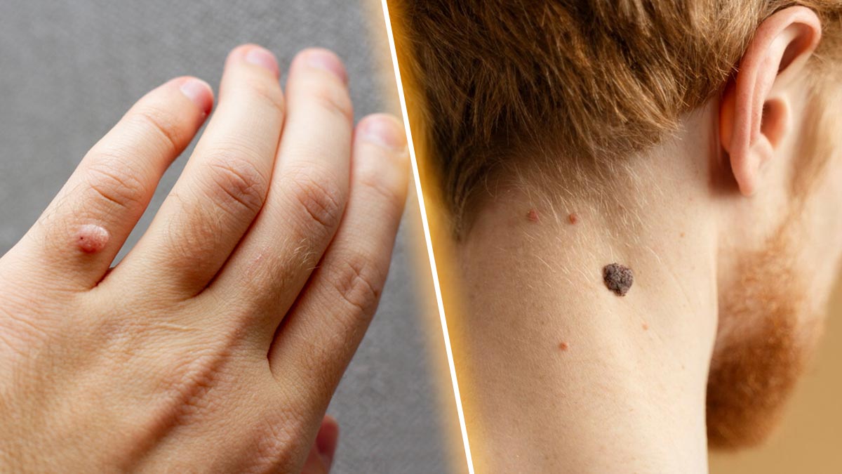 How to Remove Skin Tags and Warts Overnight: Safe and Effective Methods