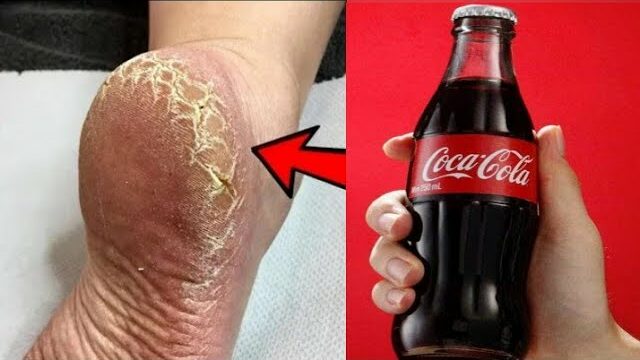 Get Rid of Cracked Heels and Enjoy Smooth, White Feet with This Simple Home Remedy