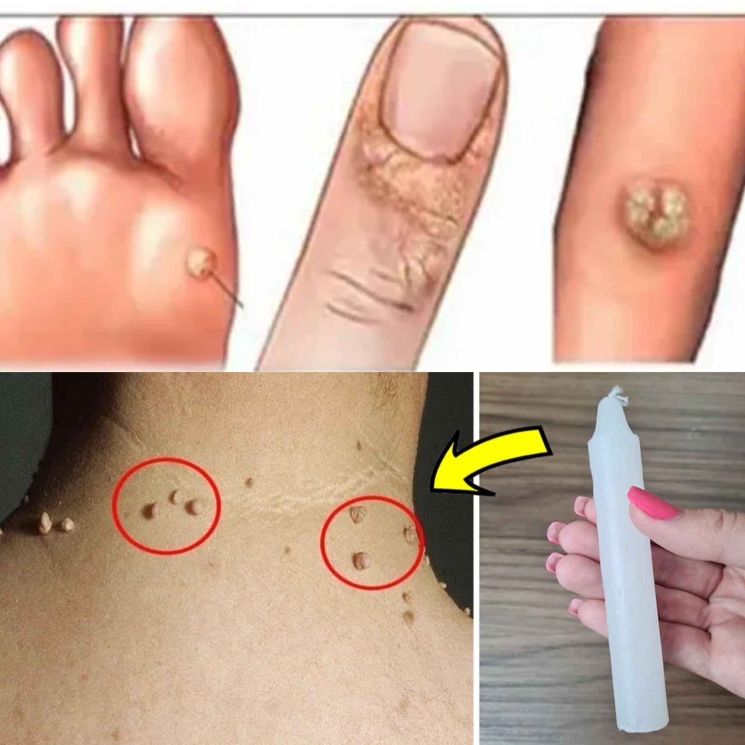 How to Eliminate Warts Forever Using a Candle