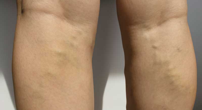 Lemon Removes Varicose Veins! Just Do This Every Day…