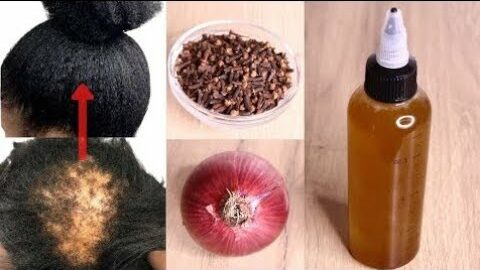 Mix Onions & Cloves and Your Hair Will Grow 3 Times Faster: A Natural Remedy for Baldness