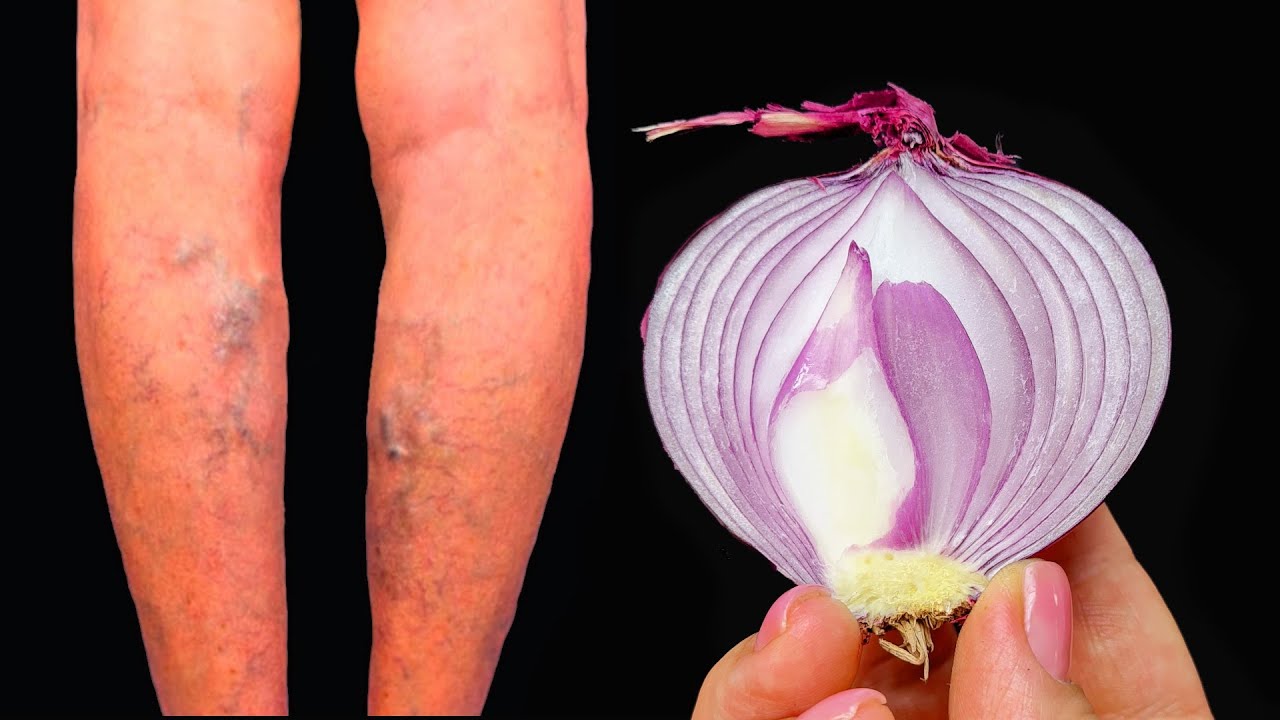 Unbelievable! 🤩 It’s a Varicose Vein Killer! Erases Varicose Veins Like an Eraser! 🔝 2 Recipes with Onion