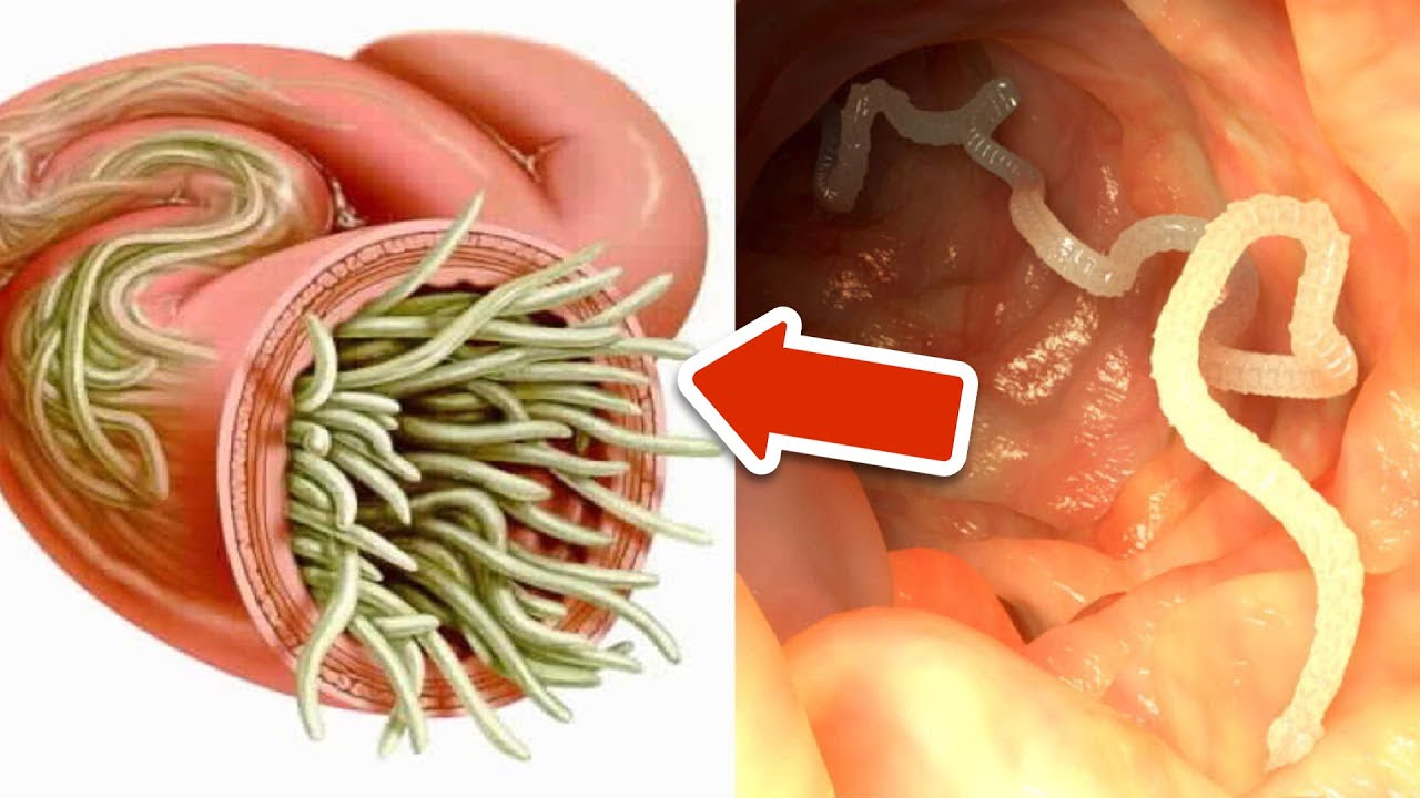 7 herbs that can kill internal parasites naturally💥(IMPORTANT)🤯