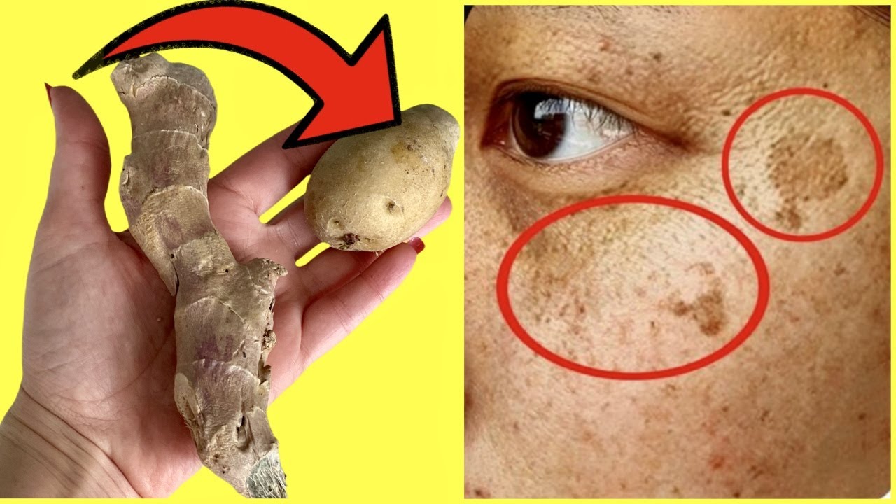 Shocking 😮She Wiped the Dark Spots Off Her Face with Potatoes and Ginger in Just 20 Minutes