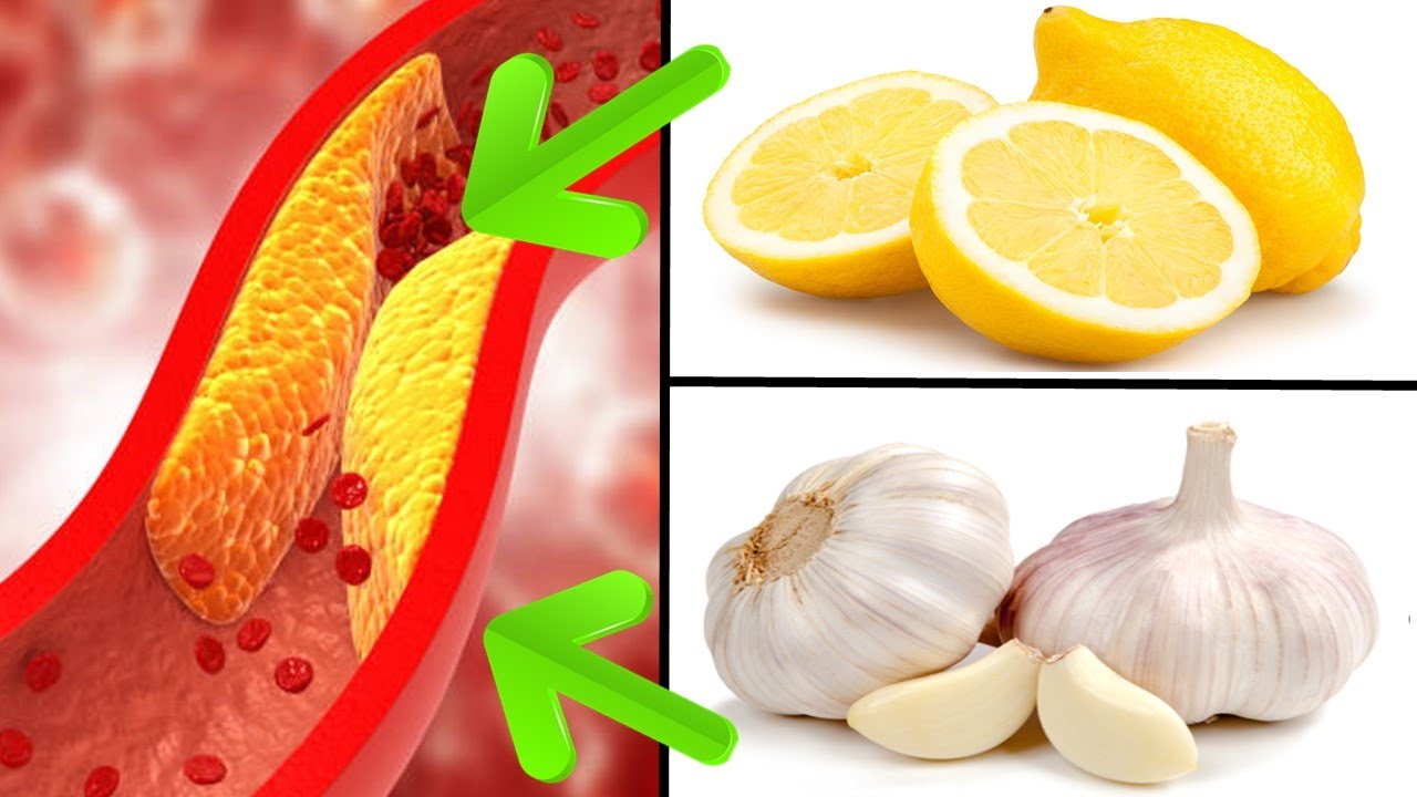 Clear Your Arteries Naturally: The Power of Lemon and Garlic Juice