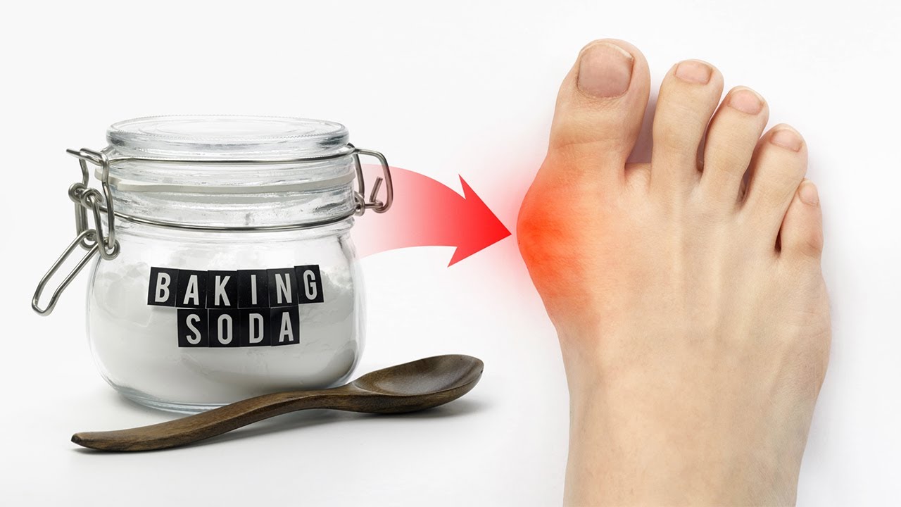 Baking Soda Miracle: Natural Relief from Gout and Kidney Stones