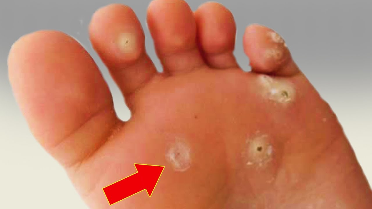 Say Goodbye to Calluses with This Natural Remedy