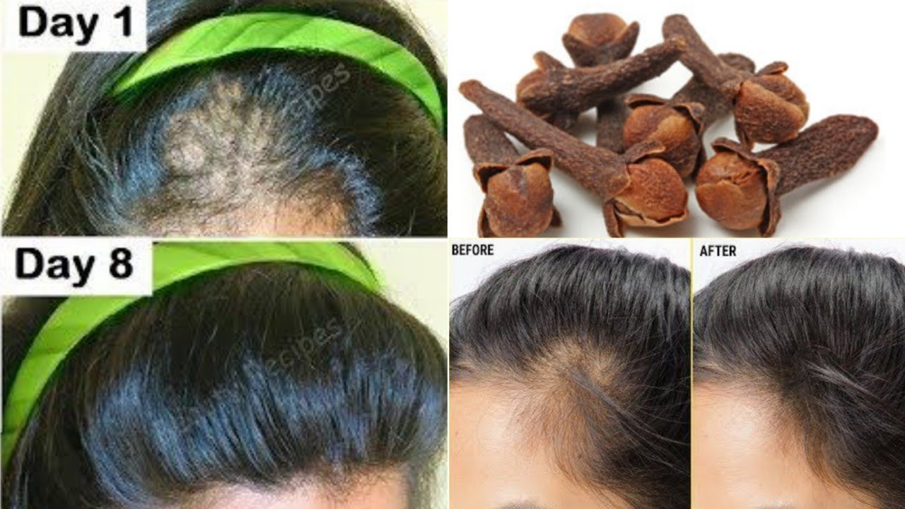 The Indian Secret 🌿 to Grow Hair at Rocket Speed and Treat Baldness from the First Week – with Cloves